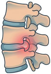 Illustration of a herniated disc pressing on the spine