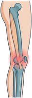 Illustration of the IT band along the outer thigh and knee