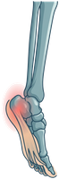 Illustration of the foot and plantar fascia with heel pain