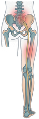 Illustration of a person with radiating lower back pain