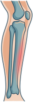 Illustration of the shin bone with pain along the tibia